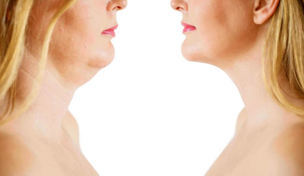 Double Chin treatment Acton Green before and after results