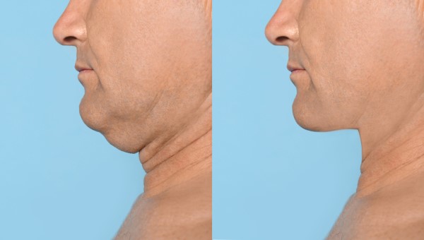 Which Non-Surgical Treatments Work Best for Jowls and Loose Skin Acton Green?