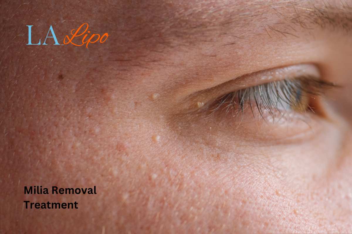 Cryopen Milia Removal: Is It the Easiest and Safest Option Acton Green?