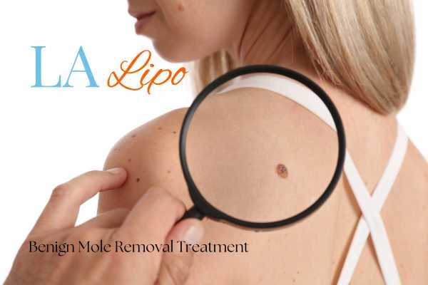 Woman having her inspection of blemish before mole removal Acton Green