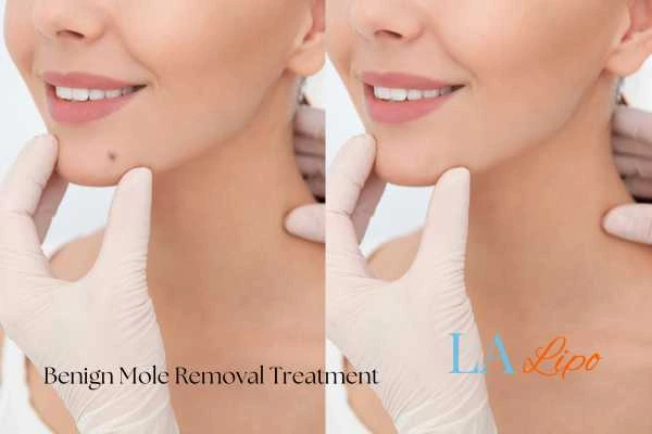Before and after mole removal Acton Green treatment