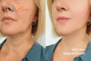 hi-fu for wrinkles Acton Green before and after results