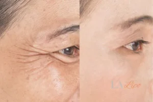 Before and after results of woman - HI-fu wrinkles reduction treatment Acton Green