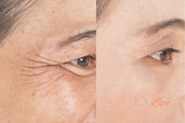 Before and after results of woman - HI-fu wrinkles reduction treatment Acton Green