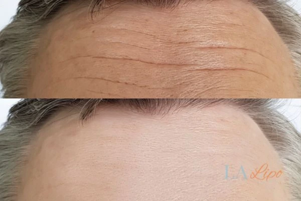 results of HIFU Acton Green on mans forehead to help reduce lines and wrinkles