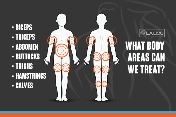 Graphic to show areas you can have LA-EMS Body Sculpting Acton Green treatment.