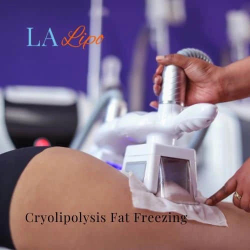 fat freezing - Cryolipolysis Acton Green
