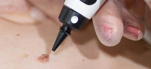 skin tag removal using cryopen Acton Green