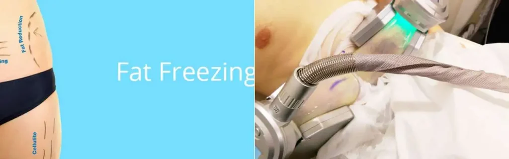 multi areas of a persons body having coolsculpting Acton Green treatment