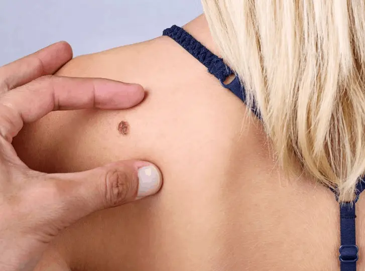 woman having mole removal Acton Green consultation before treatment.