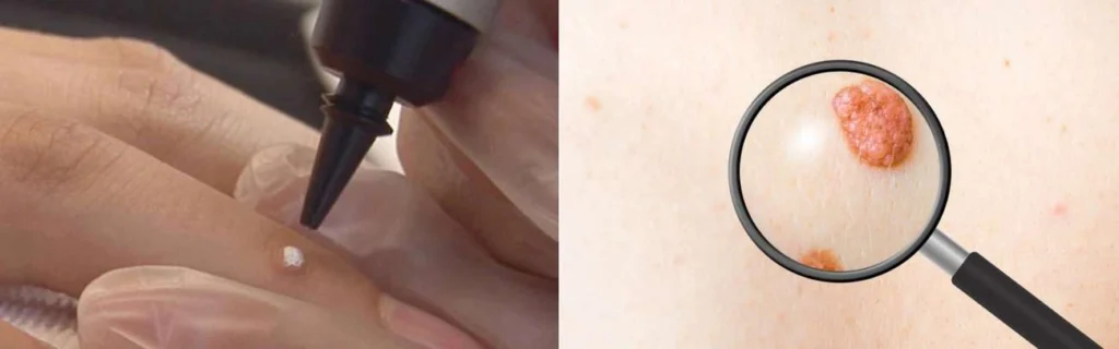 Person getting moles removed with cryopen Acton Green