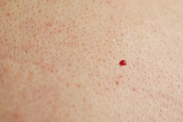 close up of a cherry angioma Acton Green