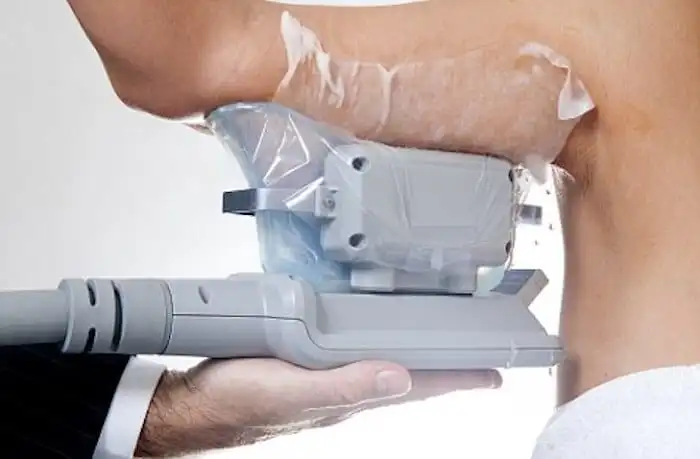 Picture of fat freezing Acton Green on the upper arms.