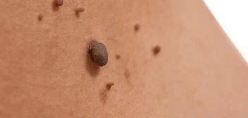 image of a skin tag Acton Green