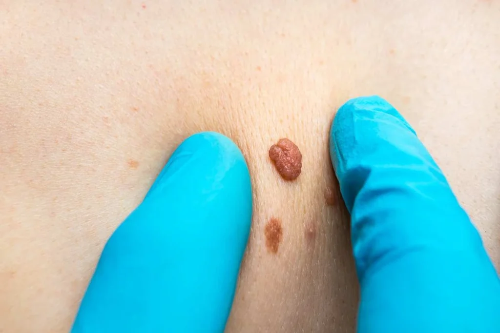 Consultant examining a skin tag Acton Green