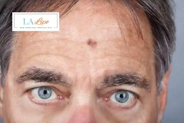 Solar Lentigo Removal Acton Green image of man with mark on his forehead