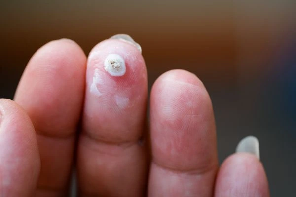 wart on person finger - cryotherapy to treat from LA LIPO Acton Green