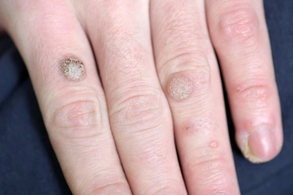 photo of warts on person hand - see wart removal Acton Green from LA LIPO