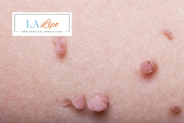 Does cryopen skin tag removal Acton Green hurt? Find out now call our team today!