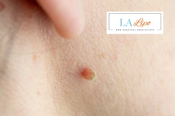 Book skin tag removal Acton Green today speak to our team now!