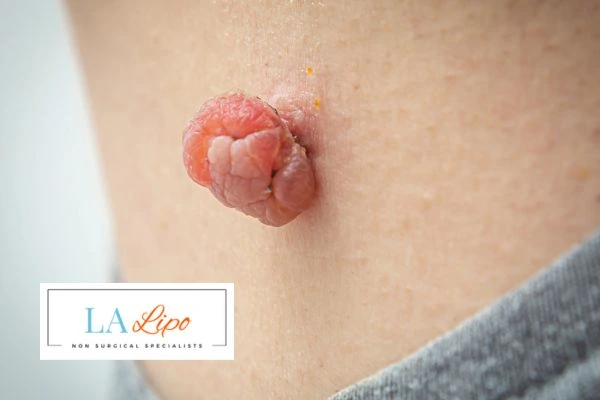 Interested in skin tag removal Acton Green? Concerned about the pain? Find out more today!