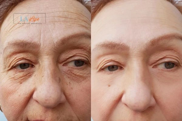 The powerful benefits of Morpheus8 Treatment Acton Green - Call Our team today!