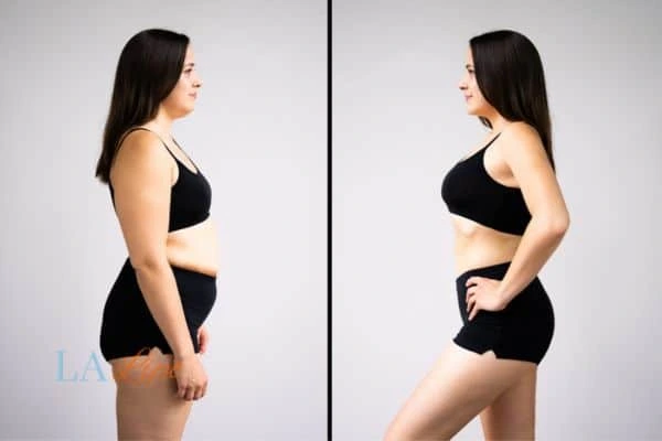 Picture of womans before and after using LA-EMS body sculpting to improve her core strength Acton Green