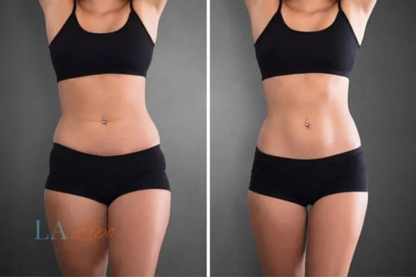 before and after results of non-surgical treatment to help a woman's body image and mental health Acton Green