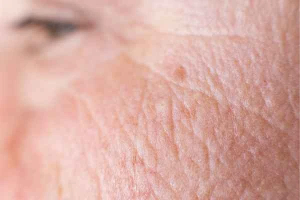 close up picture of a woman's face showing an age spot Acton Green