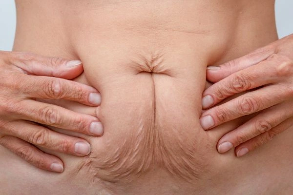Image of a woman's stomach with loose skin - example of skin tightening Acton Green options