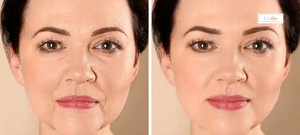 How Long Does It Take to See Results and How Long Do They Last Acton Green?