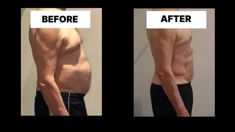 What Symptoms Can Diastasis Recti Cause in Men? Weak Core, Back Pain and Poor Posture Acton Green